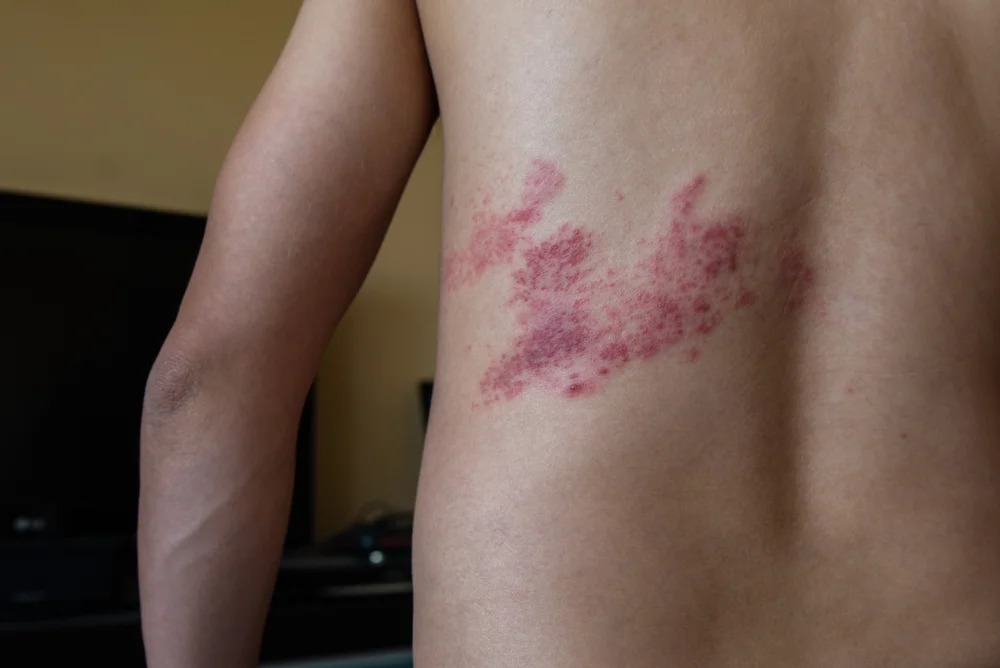Herpes Zoster