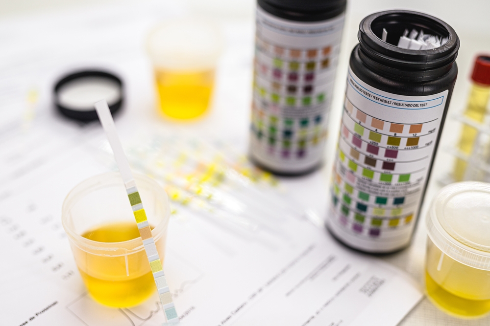 Diagnóstico de infecção urinária: como é feito?