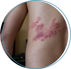 Herpes Zoster