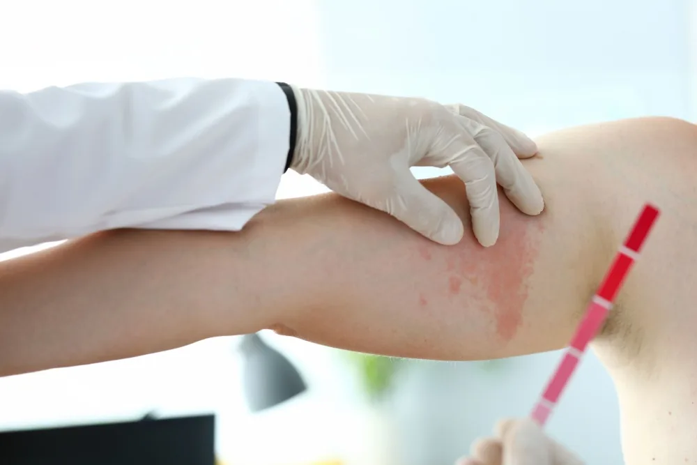 Lesões do HIV na pele: saiba tudo sobre!