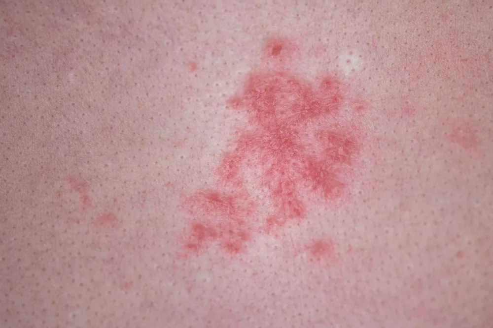 Feridas do HIV: quais são, como surgem e quando procurar um médico?