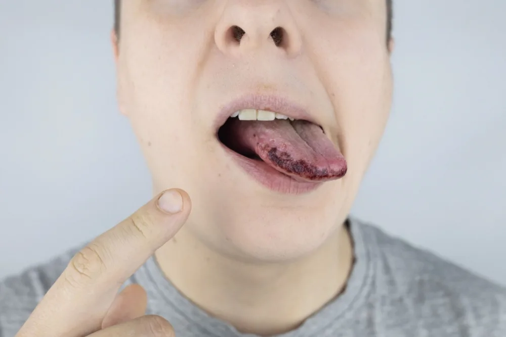 Sintomas de HIV na boca: identifique os primeiros sinais e saiba como tratar